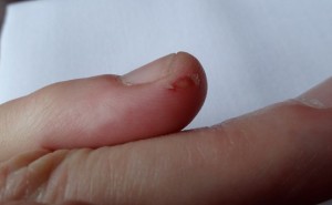 Simon Nicol's papercut finger